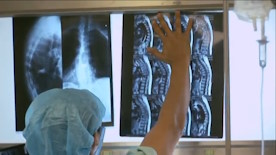 Caso de éxito contra la osteoporosis